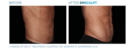 emsculpt san antonio|Iba pa.